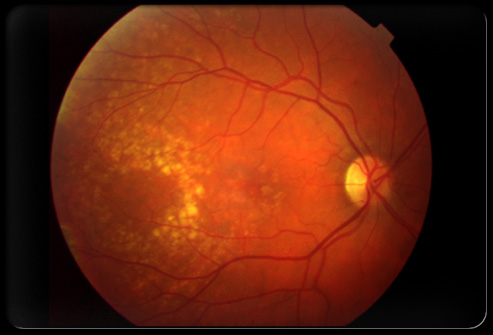 You are currently viewing Forholdsregler ved macular degeneration